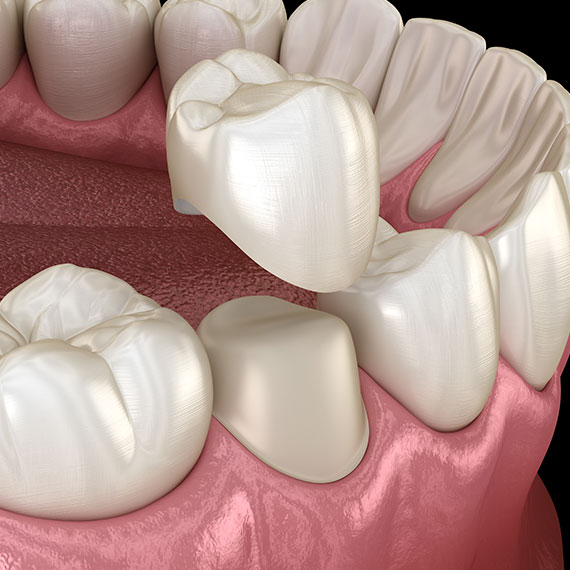 Dental crowns near you