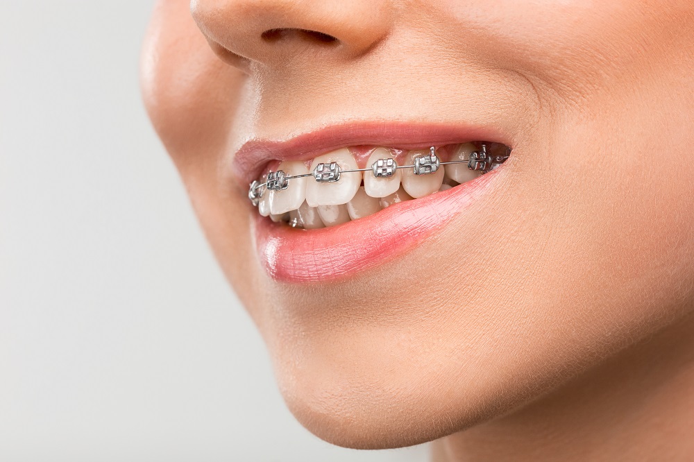 woman smiling after wearing braces