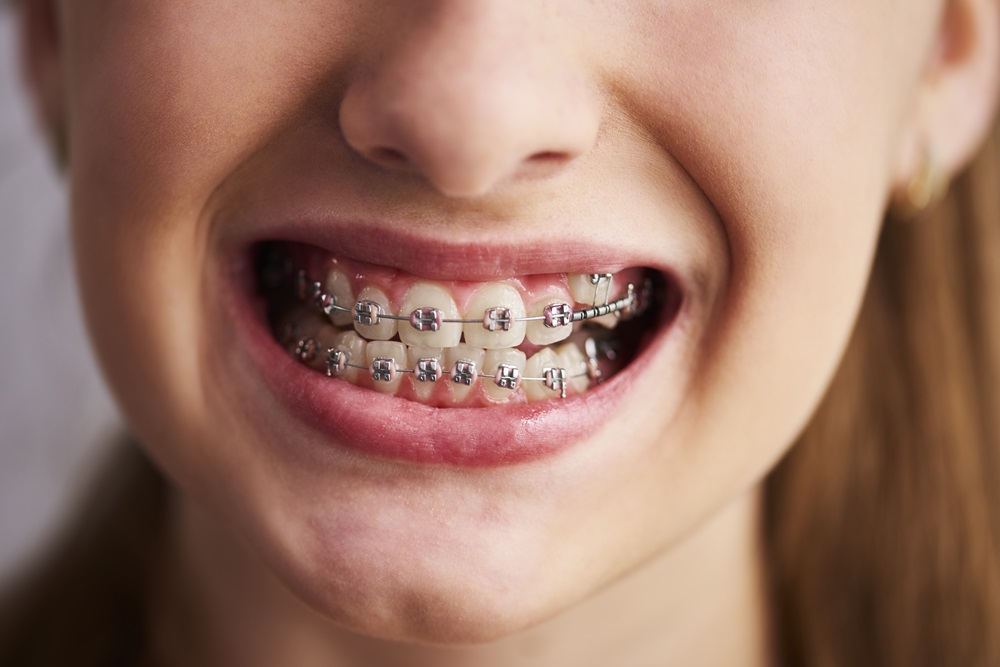 girl wearing dental braces