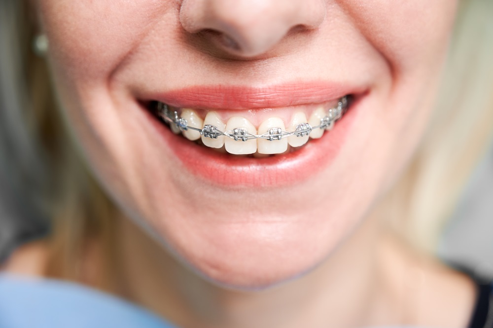 woman wearing braces