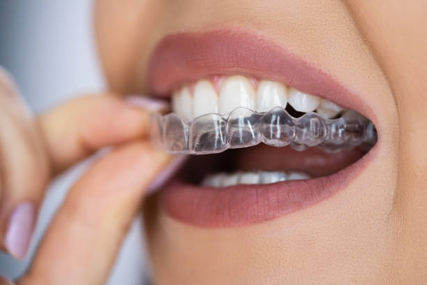 Invisalign - ORB Dental