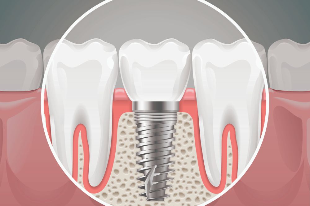 dental implants