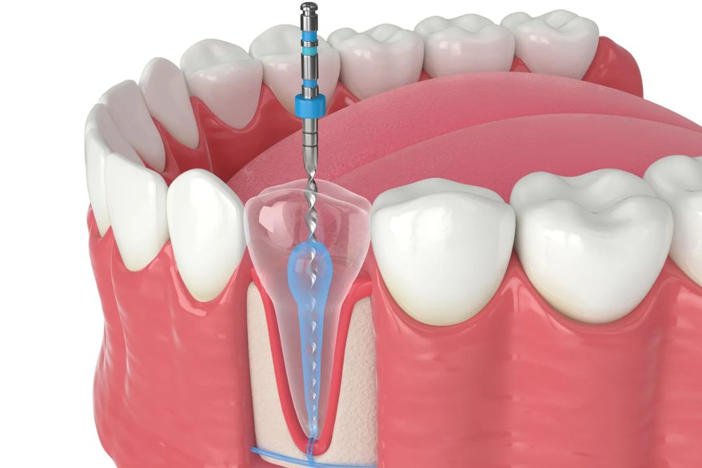 root canal in Scarborough